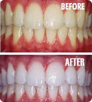 Whitening – Before and After