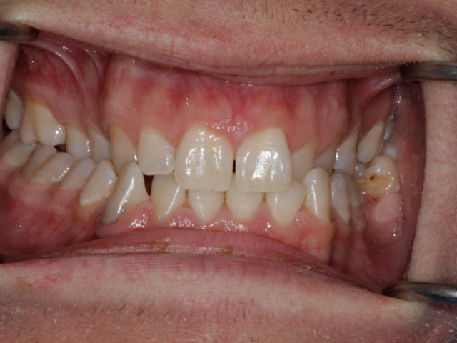 Before — Teeth Straightening