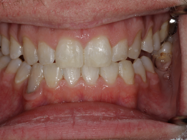 After — Teeth Straightening