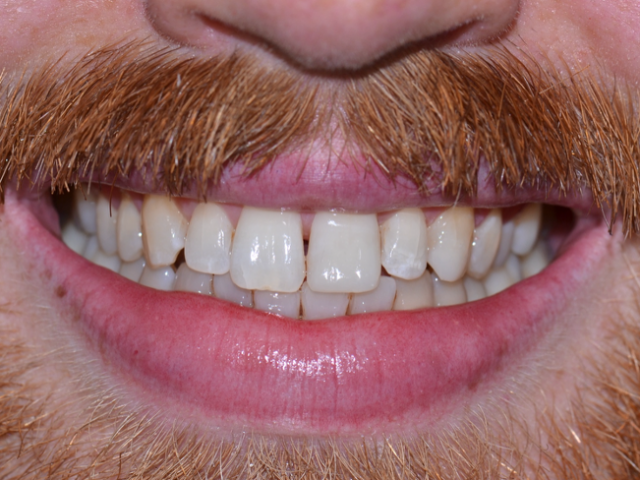 After — Composite Bonding