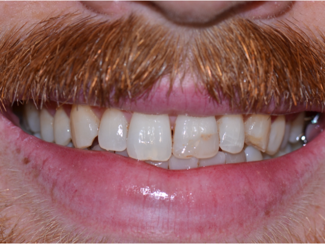 Before — Composite Bonding