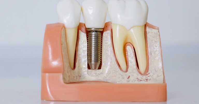 Cross-section dental implant model showing a titanium implant screw fused into the jawbone between two natural teeth — dental implants in Archway and Holloway