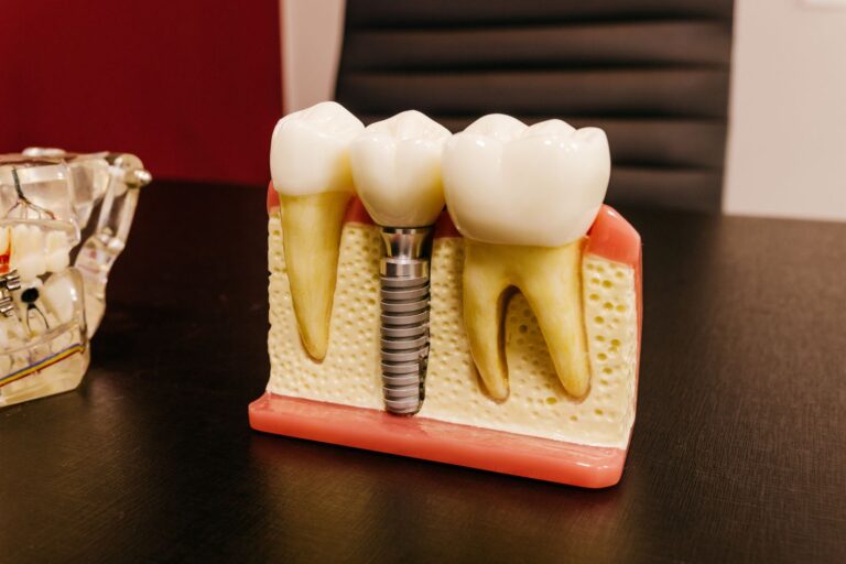 Dental implants with screw on a table in a clinic, illustrating dental implants cost in Archway