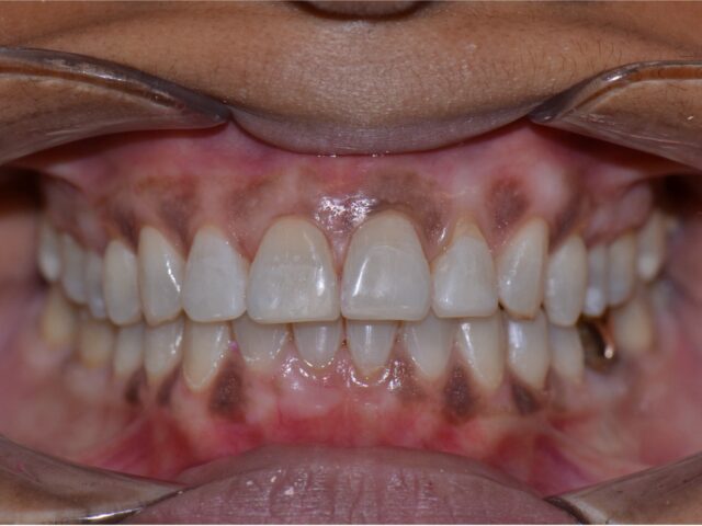 After — Invisalign