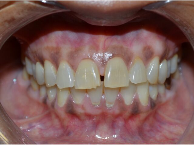 Before — Invisalign