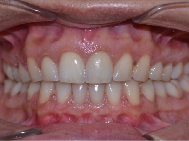 After — Invisalign Gap Closure
