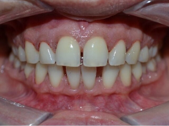 Before — Invisalign Gap Closure