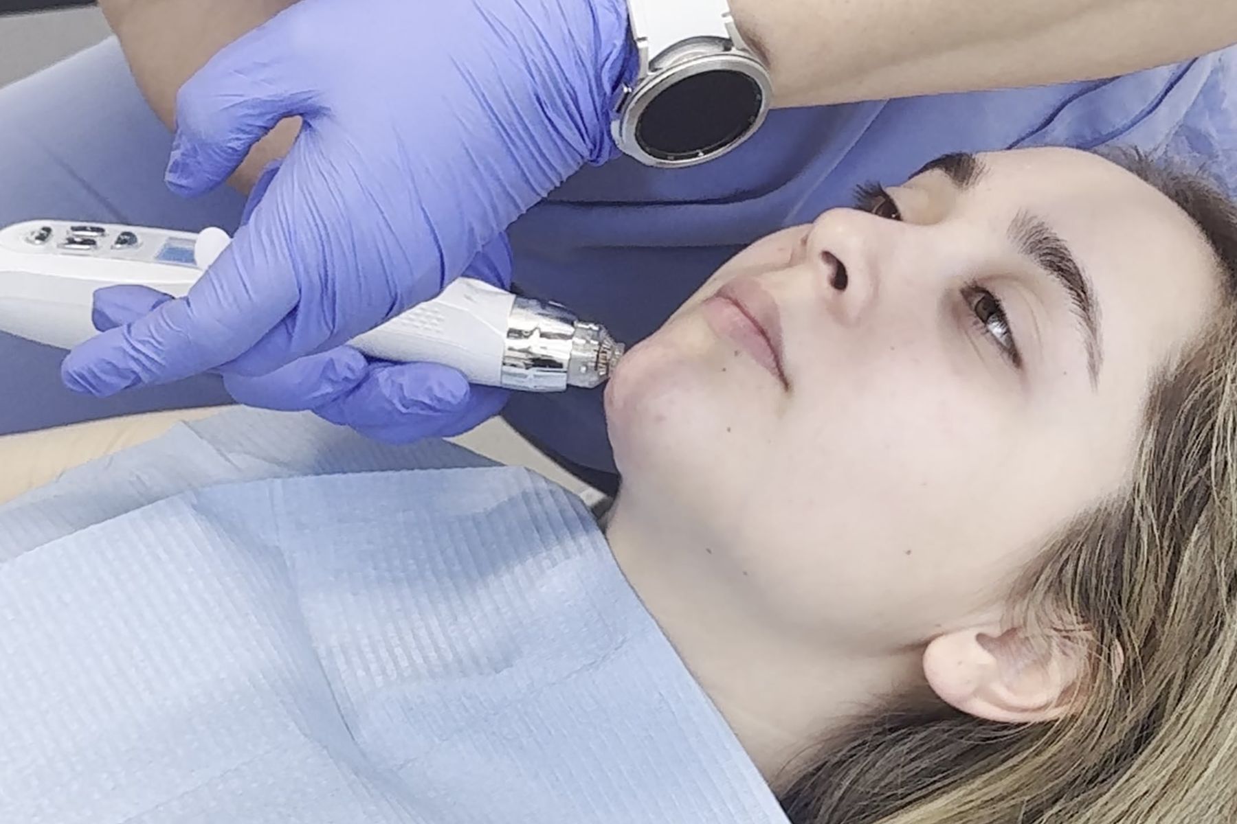 Clinician performing microneedling with a professional pen device at Blue Light Dental & Aesthetics in Archway