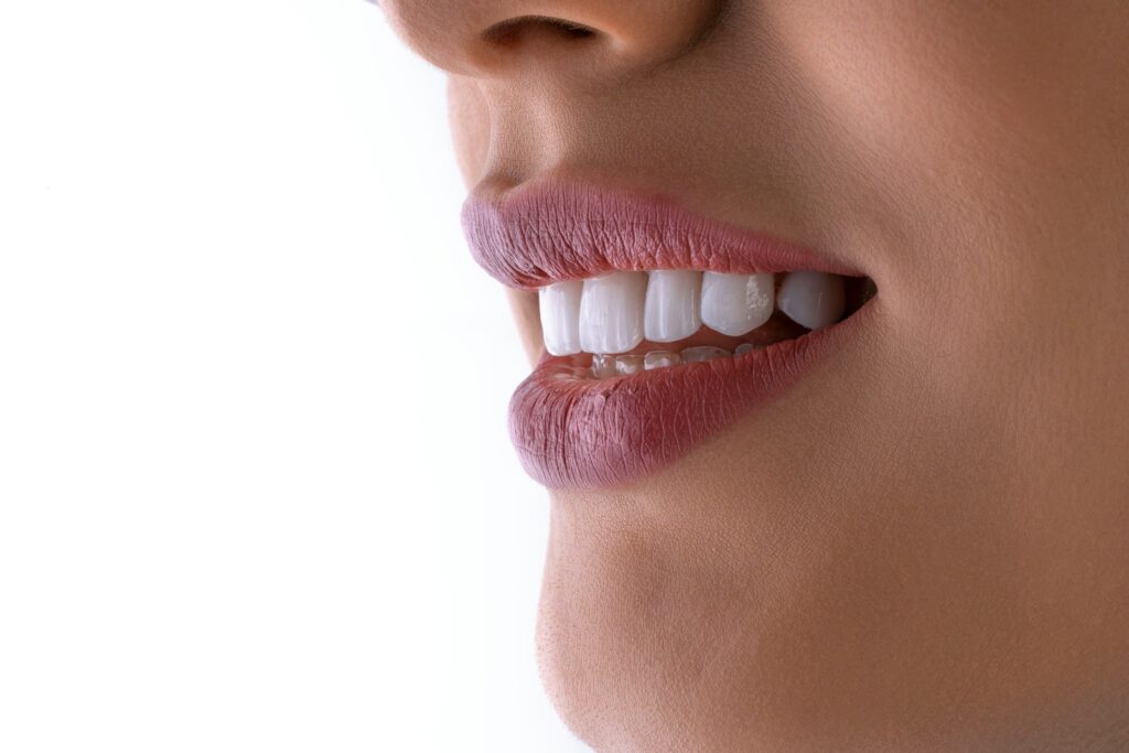 Close up of a woman's smile showing natural white porcelain veneers, illustrating porcelain veneers in North London