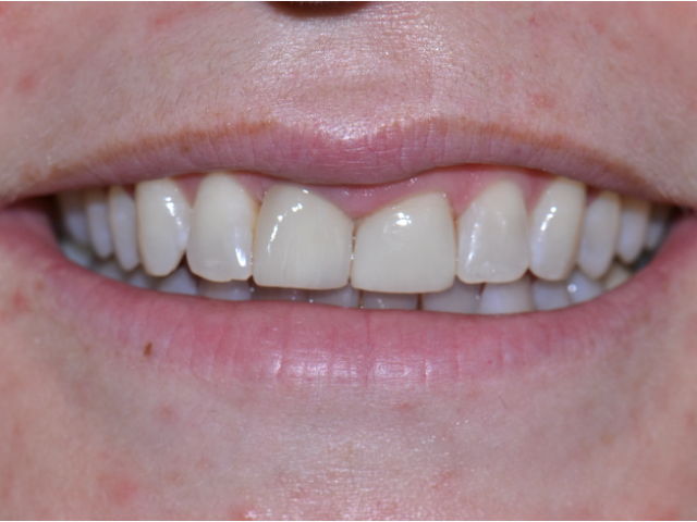 After — Veneers