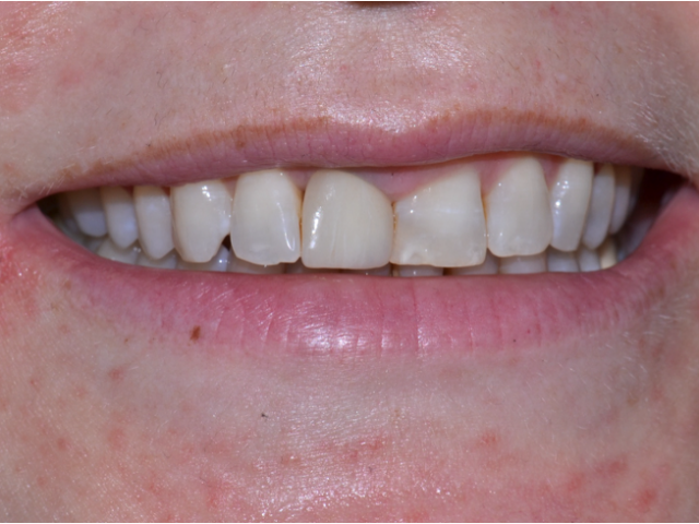Before — Veneers
