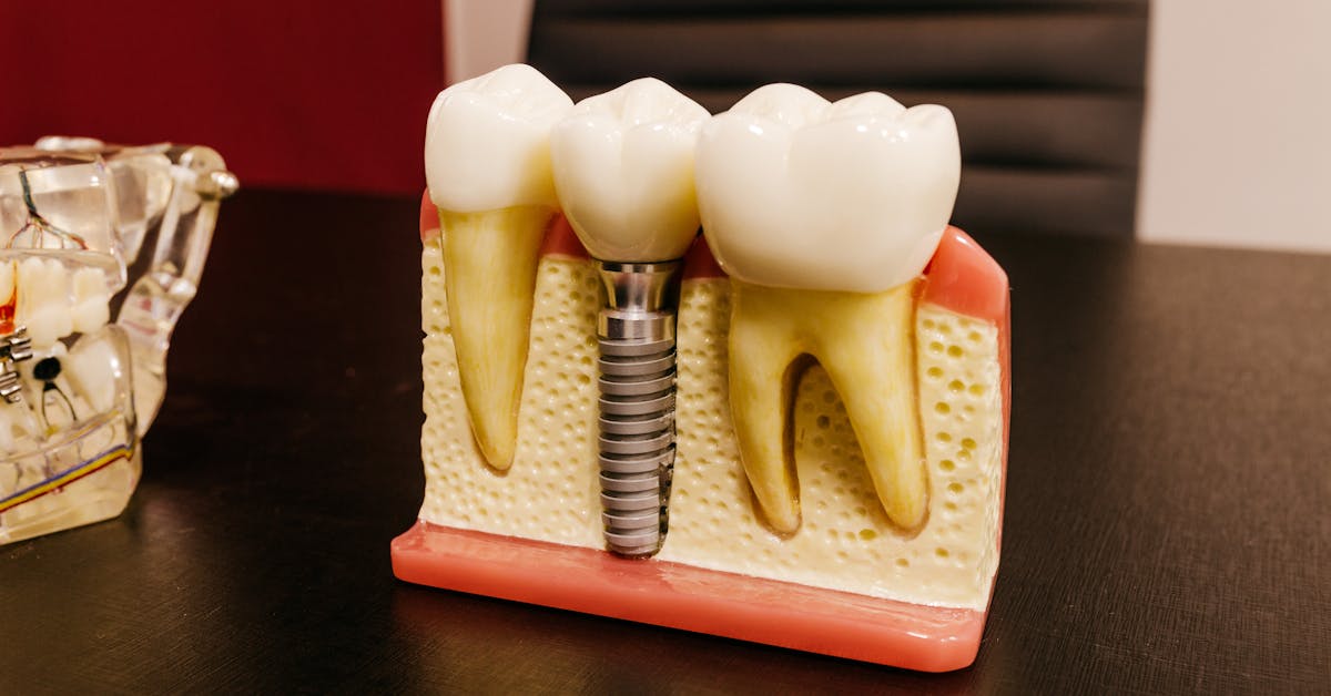 Dental implants on a clinical workspace — start your dental implant journey at Blue Light Dental